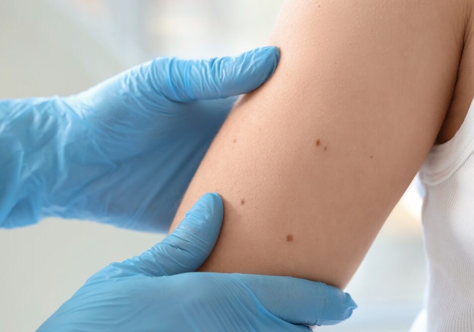 Dermatologist,Examining,Moles,On,Young,Woman,In,Clinic,,Closeup