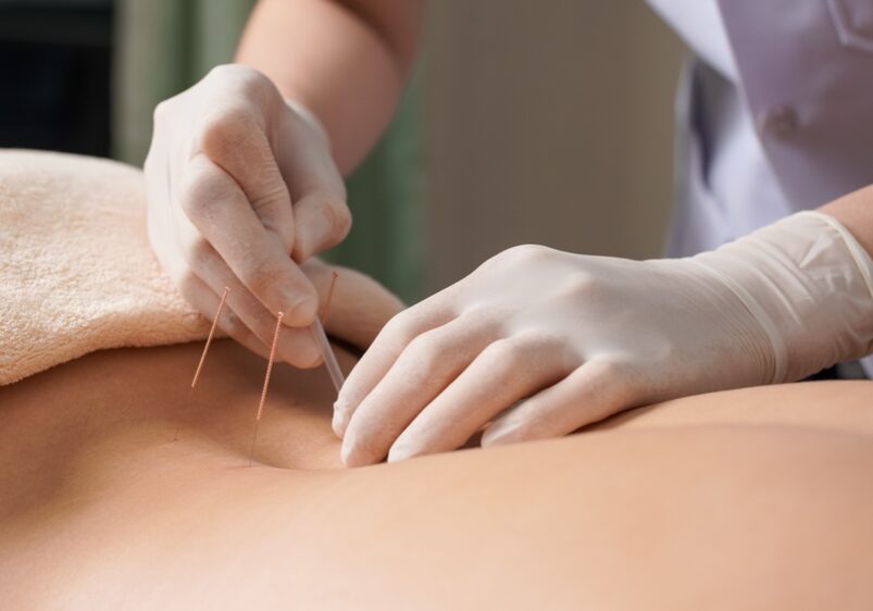 Acupuncture,For,Woman,Back,To,Relieve,Pain.